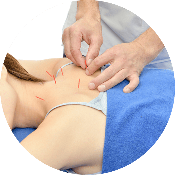 鍼施術 - とし鍼灸整骨院(摂津市)